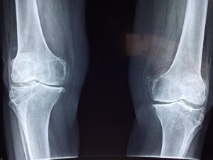 Plantar Warts Knee: Managing and Treating Plantar Warts on the Knee 2 Plantar Warts Knee: Managing and Treating Plantar Warts on the Knee